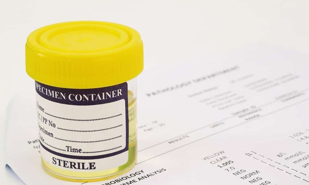 Vous devez faire un test d'urine avant de prendre des antibiotiques